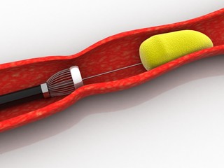 3d illustration Stent angioplasty procedure with placing a balloon