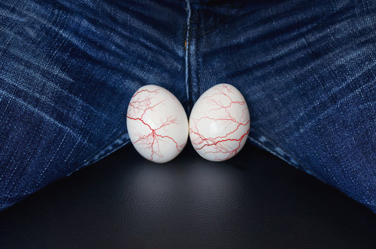 White eggs - a symbol of man's balls. varicocele - male disease leading to infertility in men. the concept of risk urological diseases. Varicose veins on the testicles.