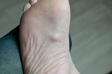 Plantar fibromatosis fascialis also known as Ledderhose's disease on the bottom of a foot front view