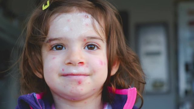 chicken pox varicella disease of child face portrait