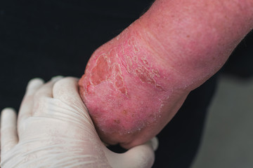 doctor examines a woman's hand burned in the sun