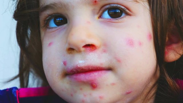 Chickenpox Rash Close Up Red Dots Skin Condition On Children Face Details Pus