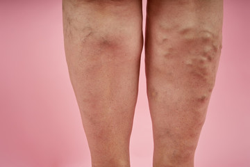 legs of senior woman with varicose veins on coral background.