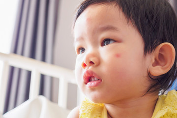 Cute little asian girl with allergy red spot face cause by insect bite