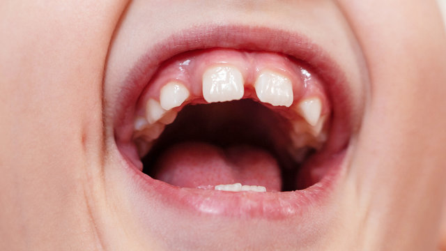 gaps between teeth. rarely growing teeth. wide open mouth. the cry of a child