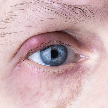 Infected purulent eye. close up eye infection