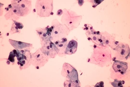Abnormal squamous epithelial cells view in microscopy.Low grade squamous intraepithelial lesion (L.SIL) criteria for pap smear slide cytology.Koilocyte cells.Medical background.600 X magnification