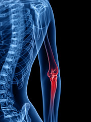 3d rendered medically accurate illustration of a painful elbow