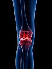 3d rendered medically accurate illustration of a painful knee