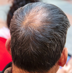 Bald head of a man at the top of the head