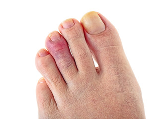 Female foot with a broken finger, white background.