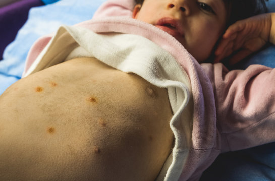 first spots of chicken pox on the baby's tummy