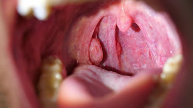 Patient With Sore Throat Examination of Strep Throat and Adenoids 