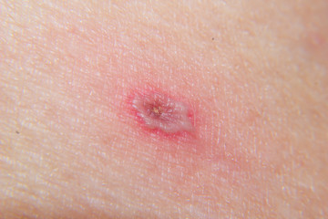 closeup of Chickenpox (varicella) on the skin in the final stages
