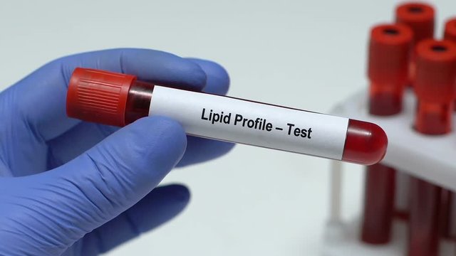 Lipid profile-Test, doctor holding blood sample in tube close-up, health checkup