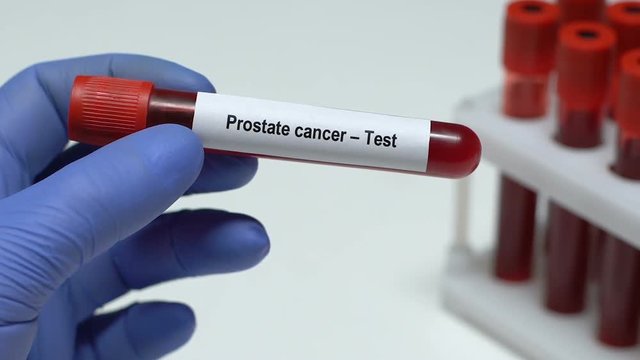 Prostate cancer-Test, doctor holding blood sample in tube close-up, health