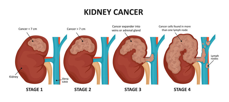 Kidney cancer stages. Malignant tumor of a kidney