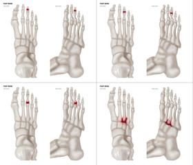 Collection Arthritis in Middle toe joint foot bone red highlights on different pain area- Anterior and Lateral view- 3D medical and Biomedical illustration- Medical Concept- Isolated white background. - obrazy, fototapety, plakaty