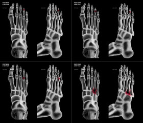 X-ray of collection arthritis ring toe joint foot bone red highlights in different pain area- Anterior and Lateral view-3D medical and Biomedical illustration-Medical Concept-Isolated black background