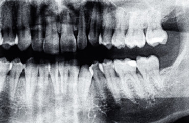 Dental X-Ray or the left side of tooth, caucasian man