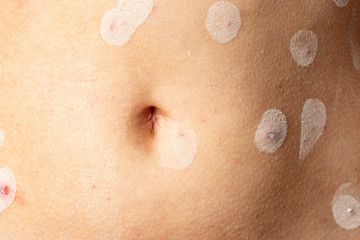 Fototapeta premium child with Varicella virus or Chickenpox close up