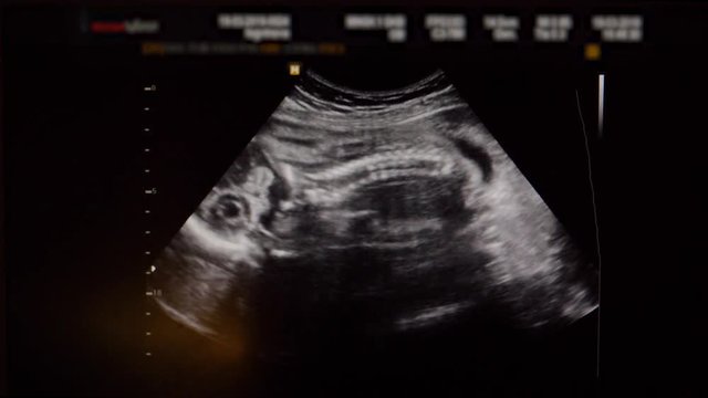 Ultrasound Of Baby In The Womb In The Second Trimester