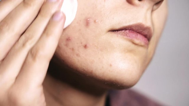 Skin problem - Woman cleaning acne face - Macro