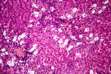 Naklejka premium Viral hepatitis, light micrograph, photo under microscope