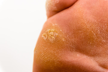 Warts on Foot and Toes