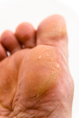 Warts on Foot and Toes