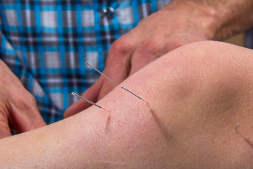 Dry Needling At The Physical Therapy Clinic - Pain Relief and Healing