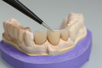 Work on tooth crown in dental laboratory