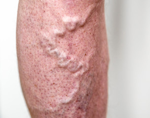 Varicose veins on human leg, vascular disease and health problem