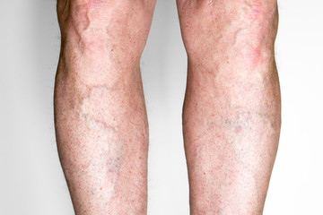 Varicose veins on legs