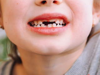 The child has a milk tooth and a new adult curve tooth. Treatment and care milk teeth in children.