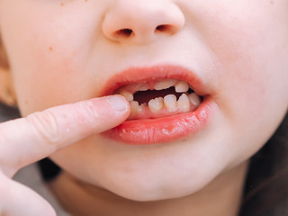 The child has a milk tooth and a new adult curve tooth. Open mouth with finger. Treatment and care milk teeth in children.