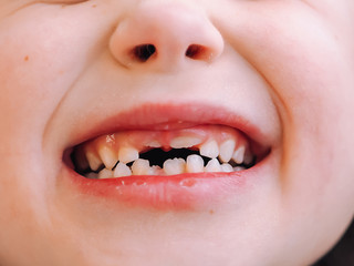 The child has a milk tooth and a new adult curve tooth. Treatment and care milk teeth in children.