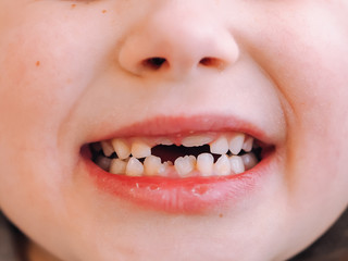 The child has a milk tooth and a new adult curve tooth. Treatment and care milk teeth in children.