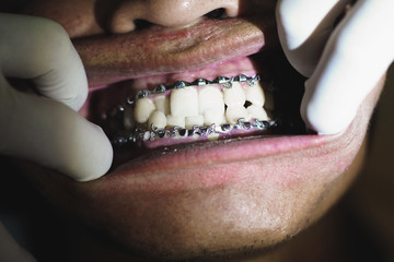 Metal dentist tool wiring fractured mandible and jaws. Bars are wired to the mandible and maxilla and allow for a closed reduction technique. © tarapatta