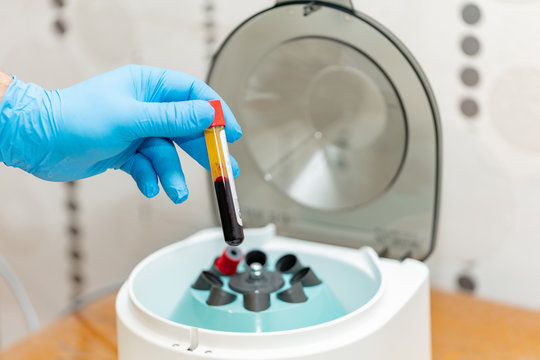 Plasmolifting PRP-Therapy