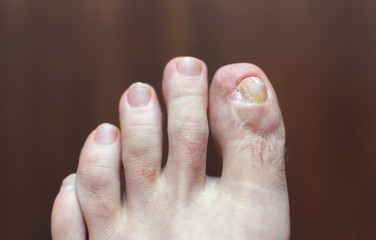 Medical photo: a deformed toe and skin condition - left foot. Old injury after accident. Dark background.