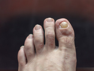 Medical photo: a deformed toe and skin condition - left foot. Old injury after accident. Dark background.