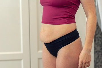 Chubby woman hand holding her own belly fat at outdoor under the sunlight