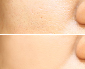 Compare before and after (retouch photo) of close up wide large pores skin on oily face have pimple...