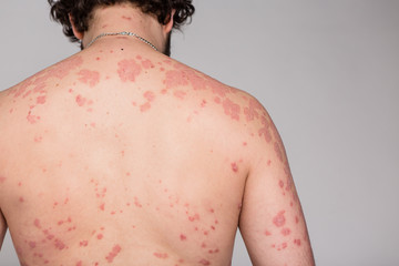 Psoriasis skin. Psoriasis is an autoimmune disease that affects the skin cause skin inflammation...