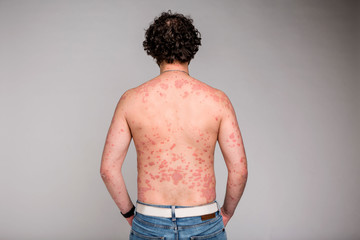 Psoriasis skin. Psoriasis is an autoimmune disease that affects the skin cause skin inflammation red and scaly - obrazy, fototapety, plakaty