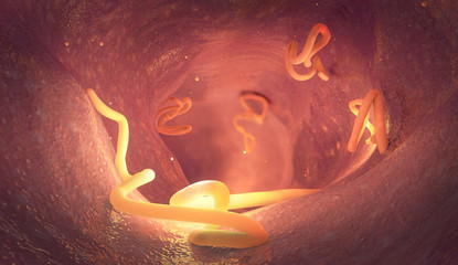 Tapeworm infestation in a human intestine - 3d illustration - obrazy, fototapety, plakaty