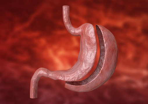 vertical sleeve gastrectomy. Bariatric surgery with reduction of the size of the stomach for weight loss and loss of body weight