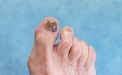 Fototapeta na wymiar Black Toenail on Foot of Senior Male Patient