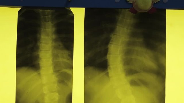 The doctor looks at x-rays of the spine